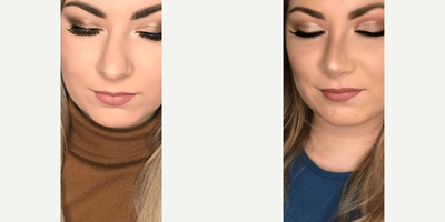 Case 3547 - Woman treated with Rhinoplasty