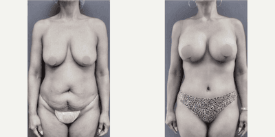 Case 355 - Woman treated with Tummy Tuck