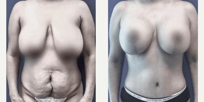 Case 356 - Woman treated with Tummy Tuck