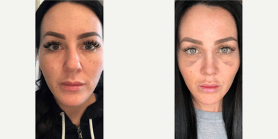 Case 3562 - Woman treated with Rhinoplasty