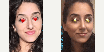 Case 3563 - Woman treated with Rhinoplasty