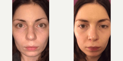 Case 3564 - Woman treated with Rhinoplasty