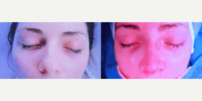 Case 3565 - Woman treated with Rhinoplasty
