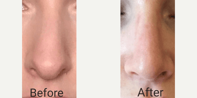 Case 3566 - Woman treated with Rhinoplasty