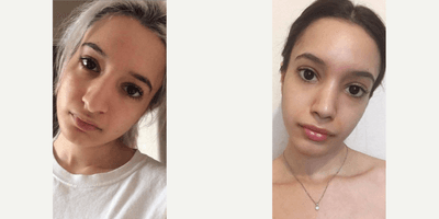Case 3568 - Woman treated with Rhinoplasty
