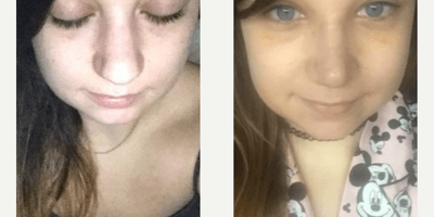 Case 3569 - Woman treated with Rhinoplasty