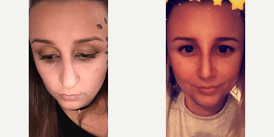 Case 3570 - Woman treated with Rhinoplasty