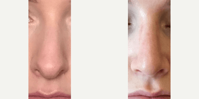 Case 3571 - Woman treated with Rhinoplasty
