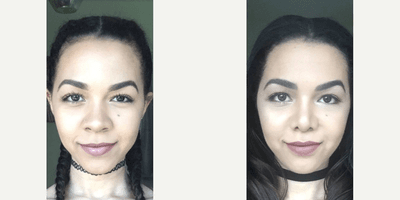 Case 3572 - Woman treated with Rhinoplasty