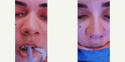 Case 3574 - Woman treated with Rhinoplasty