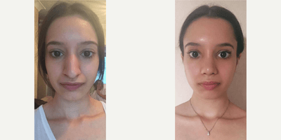 Case 3575 - Woman treated with Rhinoplasty