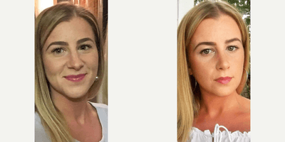 Case 3576 - Woman treated with Rhinoplasty
