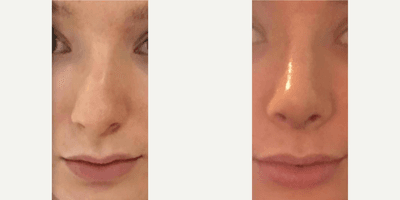 Case 3578 - Woman treated with Rhinoplasty