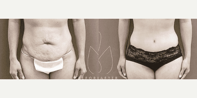 Case 358 - Woman treated with Tummy Tuck