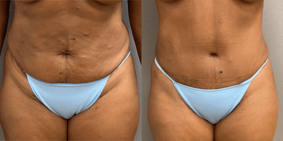 Case 377 - 42 year old woman treated with Tummy Tuck
