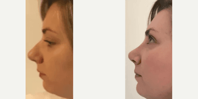 Case 3951 - Woman treated with Rhinoplasty