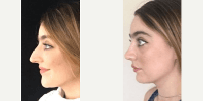 Case 3952 - Woman treated with Rhinoplasty