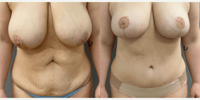 Case 404 - 25-34 year old woman treated with Tummy Tuck