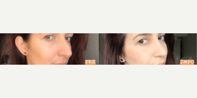 Case 4086 - Woman treated with Rhinoplasty