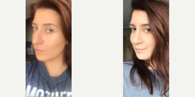 Case 4087 - Woman treated with Rhinoplasty