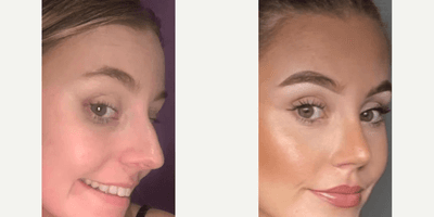 Case 4219 - Woman treated with Rhinoplasty
