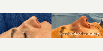 Case 4316 - Woman treated with Rhinoplasty