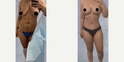 Case 436 - Woman treated with Tummy Tuck