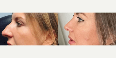 Case 4364 - Woman treated with Rhinoplasty