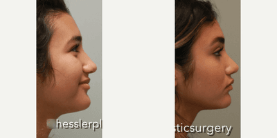 Case 4365 - Woman treated with Rhinoplasty