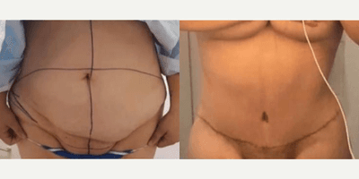 Case 437 - Woman treated with Tummy Tuck