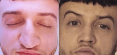 Case 4370 - Man treated with Rhinoplasty