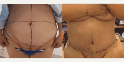 Case 438 - Woman treated with Tummy Tuck