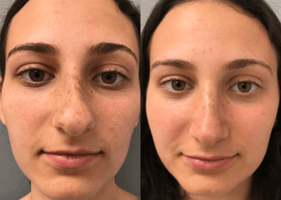 Case 4383 - 18-24 year old woman treated with Rhinoplasty
