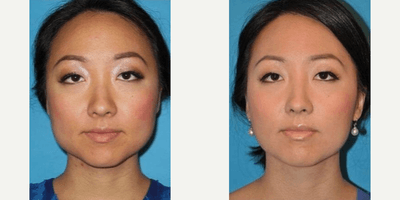 Case 4457 - Woman treated with Botox