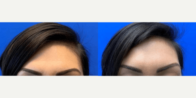 Case 4458 - Woman treated with Botox