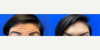 Case 4459 - Woman treated with Botox