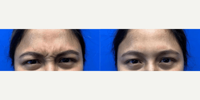 Case 4460 - Woman treated with Botox