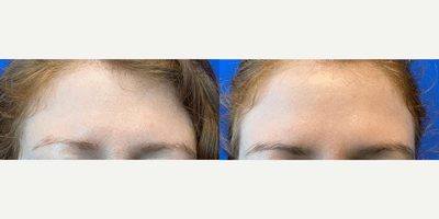 Case 4461 - Woman in her 20s treated with Botox