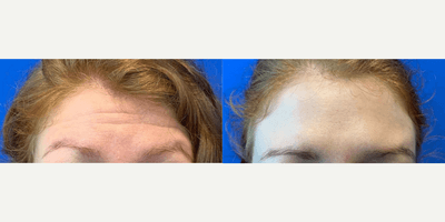 Case 4462 - Woman in her 20s treated with Botox
