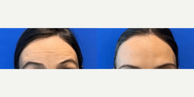 Case 4463 - Woman treated with Botox