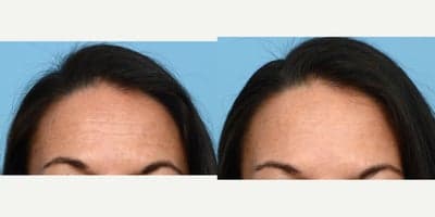 Case 4464 - 45-54 year old woman treated with Botox