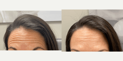 Case 4465 - 45-54 year old woman treated with Botox