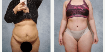 Case 459 - Woman treated with Tummy Tuck