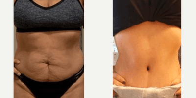 Case 460 - Woman treated with Tummy Tuck