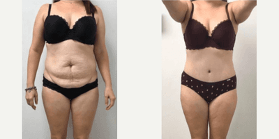 Case 461 - Woman treated with Tummy Tuck