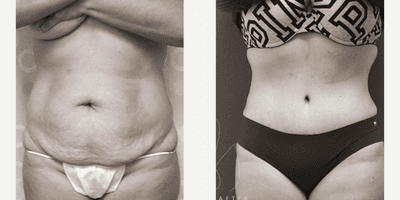 Case 479 - Woman treated with Tummy Tuck