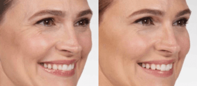 Case 5066 - Woman treated with Botox