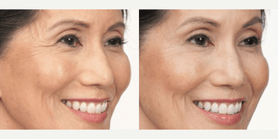 Case 5110 - Woman treated with Botox