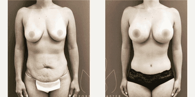 Case 517 - Woman treated with Tummy Tuck