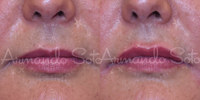 Case 5339 - Botox